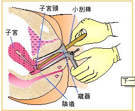 因为盆腔是腹腔在全身最低的部位,当有渗出液或漏出液时都会引流
